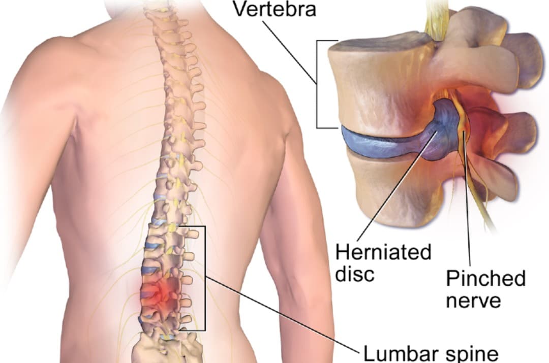 herniated disc - lower back pain diagnosis