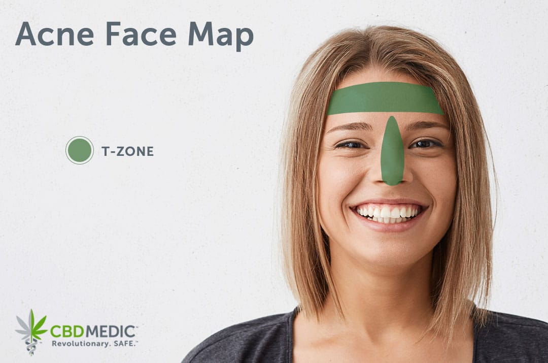 What Your Acne Says About Your Health  CBDMEDIC™