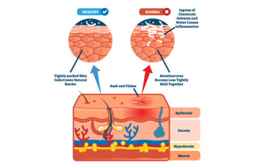 Common Causes and Triggers of Eczema | CBDMEDIC™