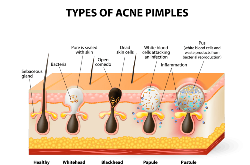 To Pop or not to Pop Pimples? That is the Question | CBDMEDIC™