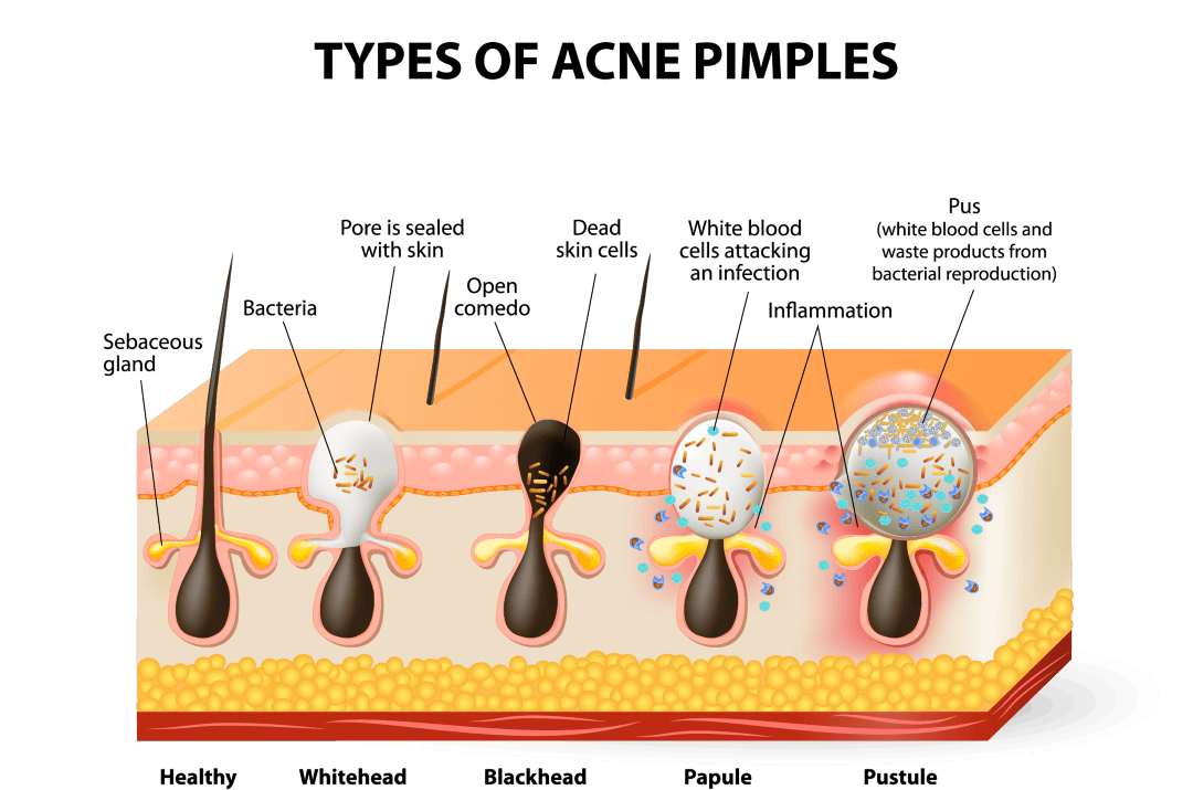 to-pop-or-not-to-pop-pimples-that-is-the-question-cbdmedic