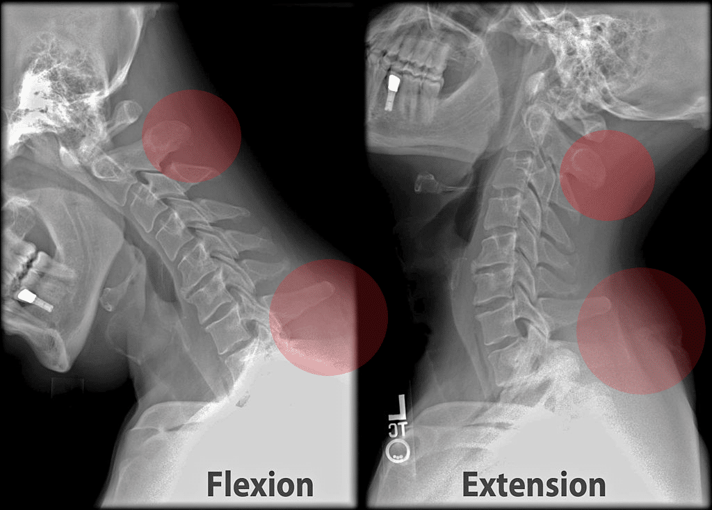 cervical xray- tech neck